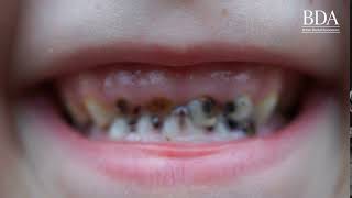 Every 10 minutes a child in England has a rotten tooth removed in hospital [upl. by Nahaj]