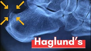 Haglund’s deformity Pump bump heel excision achilles tendinitis retrocalcaneal bursitis heel [upl. by Veriee]