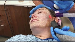 Full Face Fractional CO2 Laser Resurfacing for Wrinkles and Skin Tightening [upl. by Zilvia]