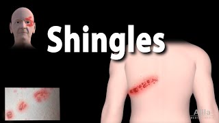 Shingles Pathophysiology Symptoms 3 stages of Infection Complications Management Animation [upl. by Darla]