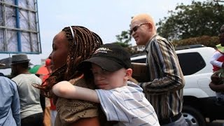 RDC les albinos en quête de reconnaissance [upl. by Inele]