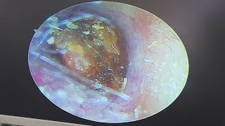 Cerumen embolism cleaning earwax Cleaning earwaxremoval satisfying [upl. by Meter840]