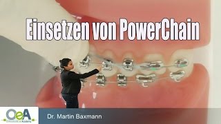 Einsetzen von PowerChain  space closure with POWERCHAIN I OeA [upl. by Naiva]