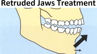 The Orthodontic Treatment of Retruded Backward Jaws Mandible with Tooth Extraction by Dr Mike Mew [upl. by Potash]