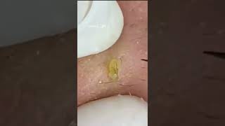 Pickel Ausdrücken Spa  Blackheads Akne amp Mitesser entfernen 🔴 17 [upl. by Nnil252]