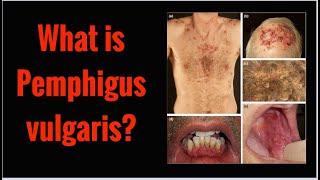 What is PEMPHIGUS VULGARIS Symptoms Causes [upl. by Salvador320]