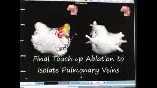 Atrial Fibrillation Ablation part 3 of 3 How to Perform Pulmonary Vein Isolation [upl. by Primrose]