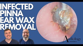 INFECTED PINNA EAR WAX REMOVAL  EP880 [upl. by Harms]