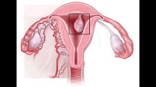 ENDOMETRIAL POLYPS [upl. by Alleuqahs]