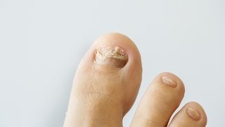 How to prevent and treat nail fungus [upl. by Billat]