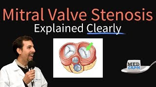 Mitral Valve Stenosis Explained Clearly  Pathophysiology Symptoms Treatment [upl. by Kramlich]