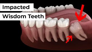 Impacted Wisdom Tooth Removal [upl. by Neerroc]