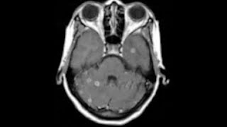 NEURORADIOLOGY CNS Infections  I  DEEPAK PATKAR  Tuberculomas vs Cysticercosis [upl. by Sabah985]