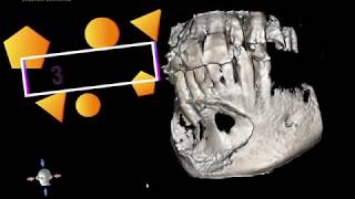 Mandibular Cyst [upl. by Kalman]