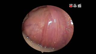 lymphoma of the left palatine tonsil endoscopy immunohistochemical histological examination [upl. by Salvay391]