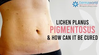 How to cure Lichen Planus Pigmentosus  Lichen Planus Pigmentosus Treatment  Dr Rohit Batra [upl. by Nnaeel]