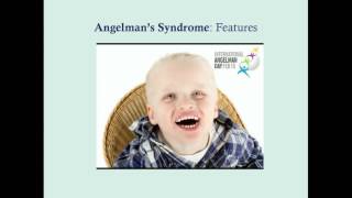 Angelmans Syndrome  CRASH Medical Review Series [upl. by Atinahs]