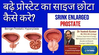 प्रोस्टेट को कैसे कम करें Prostate size Reduction How  ProfSantosh Kumar PGI [upl. by Otero818]