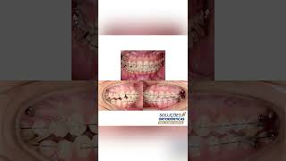 CORRECTION OF MIDLINE DEVIATION AND BOLTON DISCREPANCY  ORTHODONTIC TIPS Shorts [upl. by Ikkaj]