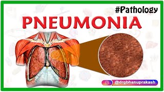 PNEUMONIA  PATHOLOGY ANIMATED VIDEO LECTURE [upl. by Newbold357]