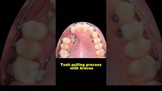 Pulling out hidden teeth when braces braces orthodontist dentist bracesoff [upl. by Eleaffar]