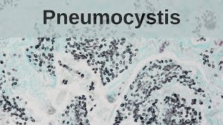 Pneumocystis Pneumonia  Pathology mini tutorial [upl. by Kirimia]