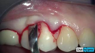 Single gingival recession treatment with Mucograft matrix [upl. by Debbi]