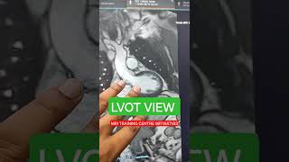 LVOT CARDIAC MRI [upl. by Fitts]