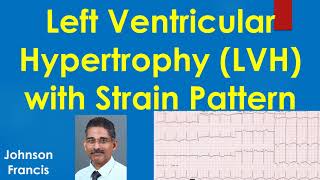 Left Ventricular Hypertrophy LVH with Strain Pattern on ECG [upl. by Arayc]