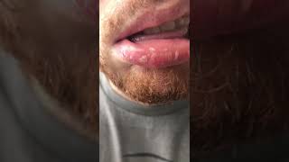 Exfoliative Cheilitis  Dovonex amp Elidel Treatment Results [upl. by Richia939]