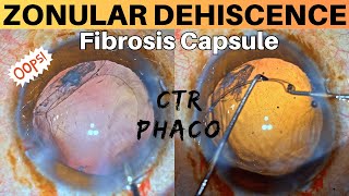 Zonular Dehiscence Noted during Phacoemulsification Management strategies  Dr Deepak Megur [upl. by Narik]