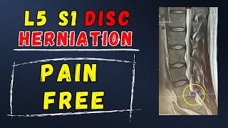 L5 S1 Disc Herniation Recovery without surgery [upl. by Nennahs]