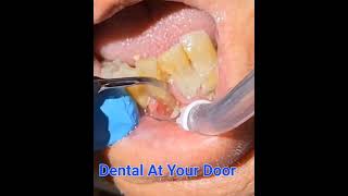 Heavy dental tartar  dental calculus removal with an ultrasonic scaler [upl. by Anah]