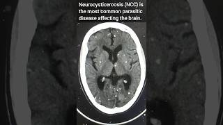 Neurocysticercosis l NCC l Stary ⭐ appearance in the brain neuroradiology radiology shorts [upl. by Rabbaj]