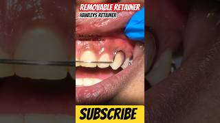 Hawley’s Retainer  Orthodontic Treatment at Delhi 5 Dental Clinic explore delhidentist shorts [upl. by Hartley]