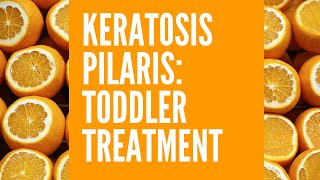 Keratosis Pilaris Toddler Treatment [upl. by Okajima]