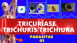 TRICURÍASE  TRICHURIS TRICHIURA VERMINOSE  PARASITOLOGIA  INFECTOLOGIA [upl. by Renick]