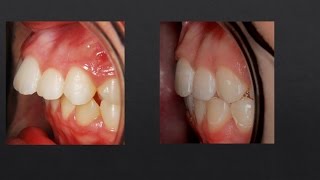 8mm Overjet Correction Orthodontics [upl. by Aneeuqal857]