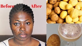 Remove dark spots in just 7 days with Potato  100 Natural [upl. by Nnaeilsel]