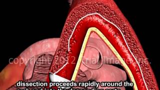 Aortic Dissection  Thoracic amp Abdominal  Animation by Cal Shipley MD [upl. by Maddox]