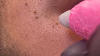 Skin Tag amp DPN Dermatosis Papulosa Nigra Removal [upl. by Dnalyk]