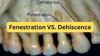 Difference between fenestration and dehiscence with mnemonic [upl. by Silloc753]