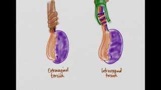 Testicular Torsion [upl. by Ynnig]