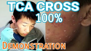 How To Use TCA CROSS 100 Demonstration  Self Treatment at home for Acne Scars Removal [upl. by Llevram250]