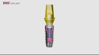 Indexing Dental Implant Abutments Correctly [upl. by Enimsay33]