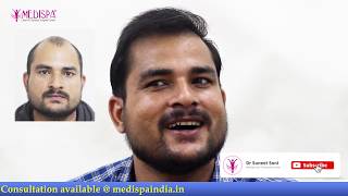 SUPER NATURAL HAIRLINE in Level 6 Baldness Hair Transplant at Medispa Dr Suneet INDIA Jaipur Delhi [upl. by Cinemod]