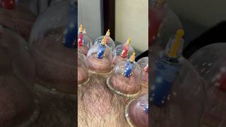 Hijama therapy hijamacupping [upl. by Arola809]