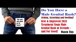 Male Genital Rash Itching Scratching Swelling 2021 Treatment Stops Male Genital Rash For Good [upl. by Erialcyram]