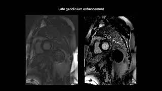 How to assess myocarditis with the help of cardiac MRI CMR [upl. by Us]