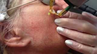 Laser treatment for facial thread veins with Candela NdYag laser [upl. by Doowrehs]